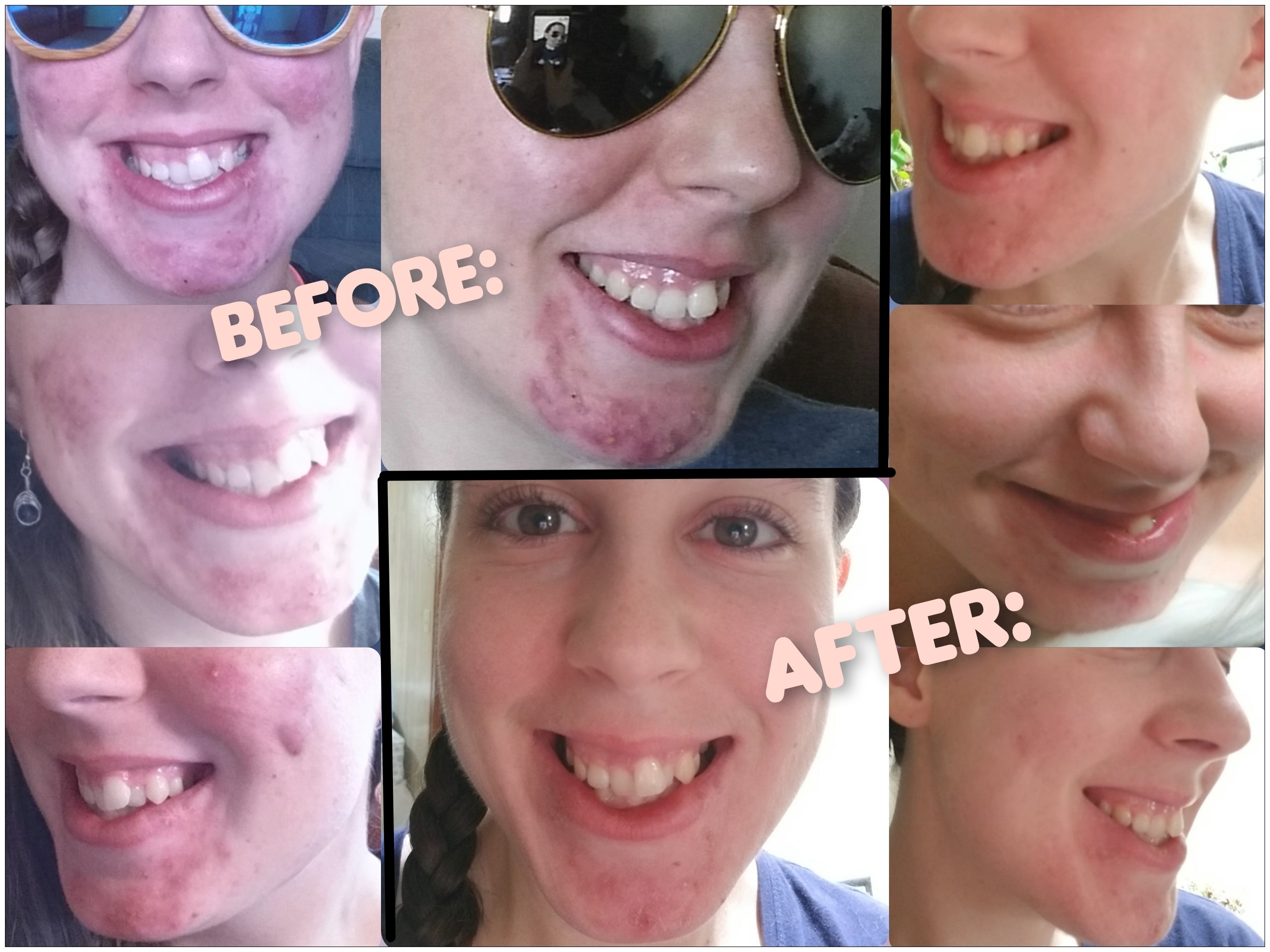 Ultimate Clear Skin Acne Healing Facial Bundle with Free Healing Cleansing Bar